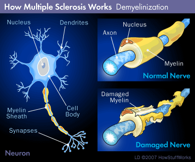 How-multiple-sclerosis-works